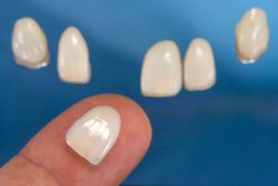 Dental Veneers For Cracked Teeth | Best Veneers for Stained Teeth