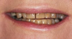 Full Mouth Reconstruction in Houston,TX | Beautiful Custom Dentures