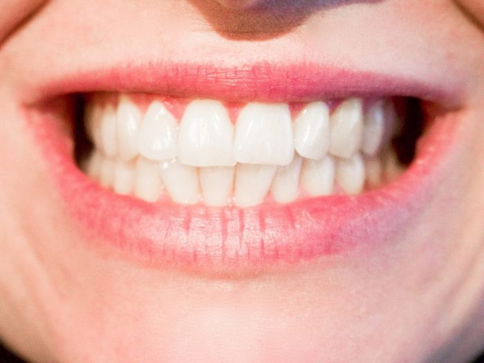 Teeth Scaling And Polishing in Houston | Dentist Teeth Cleaning