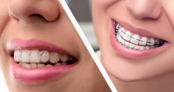 How Much Does Metal Braces Cost? | Metal braces: Uses, costs, benefits