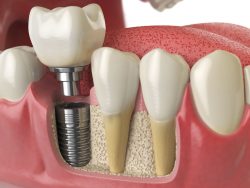 Porcelain Crown and Bridges | Single Front Tooth Crown Before And After | specializes in Porcela ...