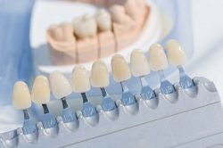 Cosmetic Dentistry Houston | Dental Veneers