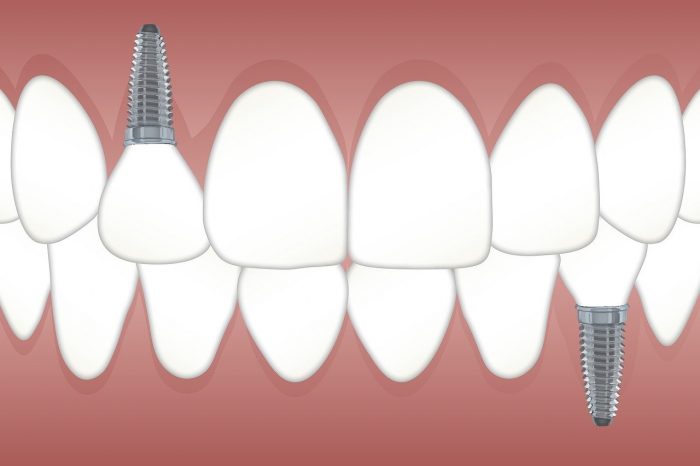 Affordable Dental Implant Manhattan NYC