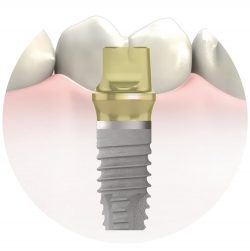 Emergency Dental Implant Manhattan NYC