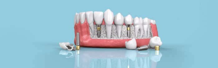 Best Dental Implant Specialist Near Me in Manhattan NYC