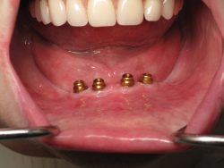 Dental Implants In Houston, TX | nearestemergencydentist