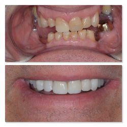 Knocked Out Tooth Treatment | dental implants in Houston