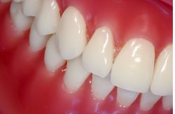 Restorative Dentistry Houston TX | Same Day Teeth Implants