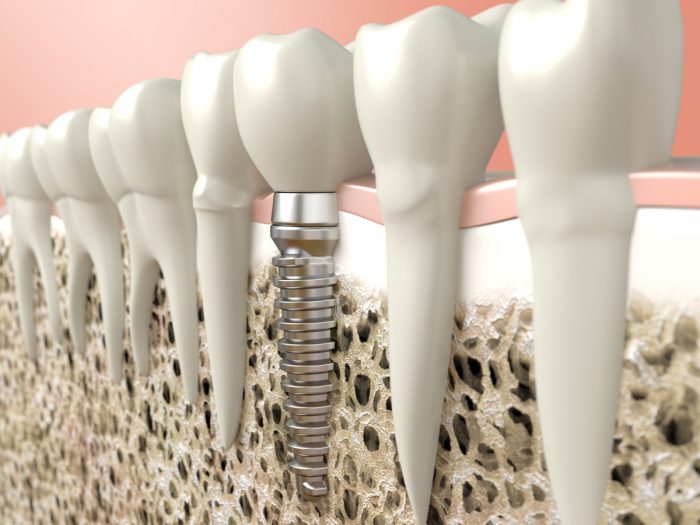 How Long Does the Dental Implant Process Take?