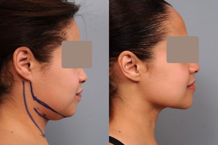 Benefits of Neck Liposuction | premieresurgicalarts