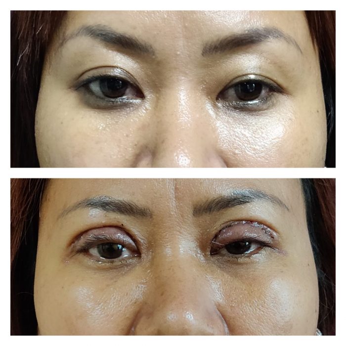 How Much Does Eye Lift Surgery Cost? | premieresurgicalarts