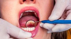 Deep Teeth Cleaning Near Me | Teeth Cleaning Before And After | Disadvantages and Advantages of  ...