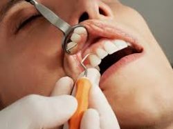 Deep Teeth Cleaning Near Me | Teeth Cleaning Before And After | How Much It Cost To Clean Teeth, ...