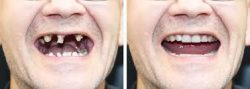 Smile Makeover Vs. Full Mouth Reconstruction: What’s The