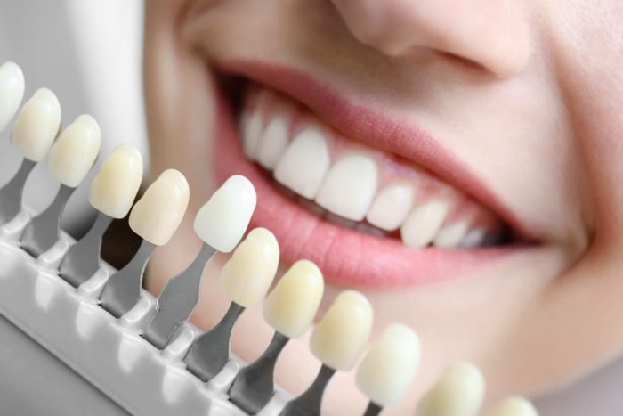 Porcelain Veneers in North Miami | sunnyislesdental