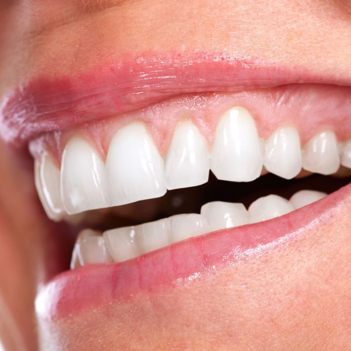 Dental Veneers in Sunny Isles Beach | sunnyislesdental