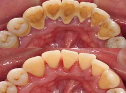 Gum Bone Regeneration Treatment in Houston | laserdentistrynearme