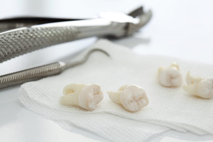 Wisdom Tooth Removal Houston TX