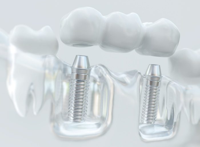 Restorative Dentistry Houston TX