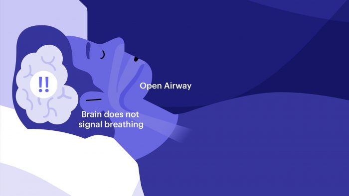 Central Sleep Apnea Treatment | Sleep Apnea: Symptoms, Causes, and Treatments