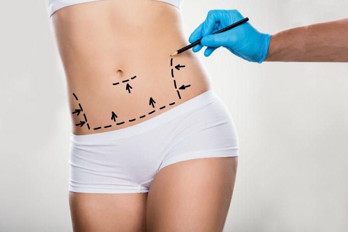 Arm Liposuction in Houston | premieresurgicalarts