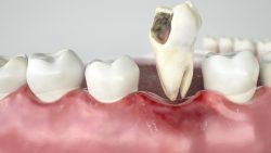 When a Broken Tooth Filling is an Emergency? | Broken Tooth Filling