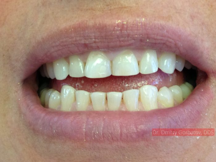 Porcelain Veneers Near Me |sunnyislesdental