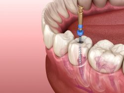 Wisdom Tooth Extraction Dentist Near ME | situations necessitate