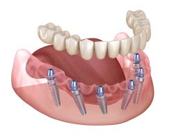 Same Day Dentures Near Me | Implant Retained Dentures Houston | denture near me
