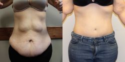 Tummy Tuck Before and After Pictures | premieresurgicalarts