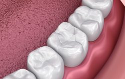What are the advantage of Composite Fillings?