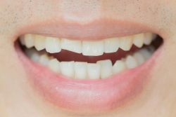 What is The Best Cracked Tooth Treatment?