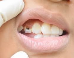 What is The Best Treatment For Broken Teeth?