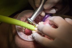 Emergency Root Canal Specialist | Root Canal Therapy Near Me