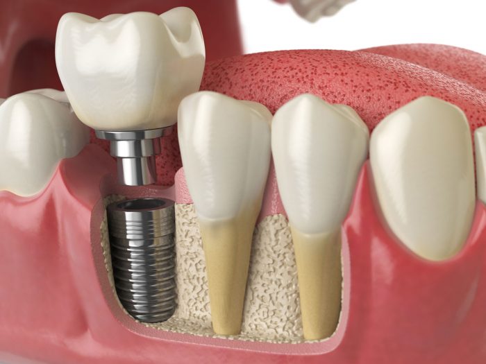 Affordable Dental Implants Near Me | Specialist Near Me