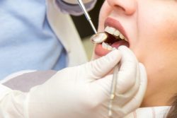 Impacted Wisdom Tooth Extraction | Teeth Extraction Near Me