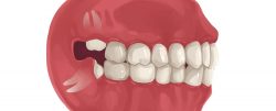 Wisdom Teeth Removal Near Me in Houston