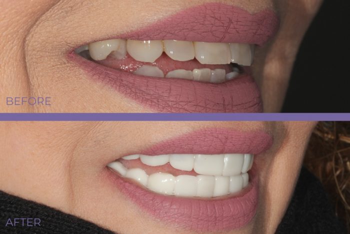 What Are Snap On Veneers?