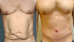 Tummy Tuck Before After Results