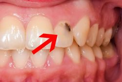 Composite Front Tooth Cavity Filling or Bonding