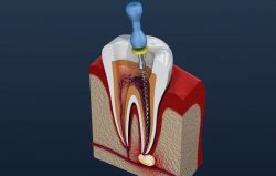 What is root canal therapy? | Root canal treatment