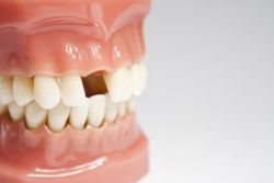 Dental Veneers for Cracked Teeth | dentistveneershouston
