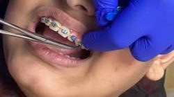 Dental Veneers Houston Tx | dentistveneershouston