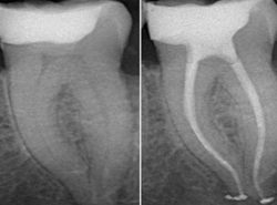 Emergency Root Canal Specialist | Dental Implants Near Me
