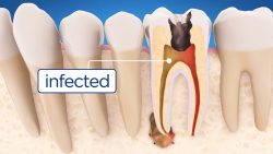Emergency Root Canal Specialist| Dental Emergency Care Clinic Near Me