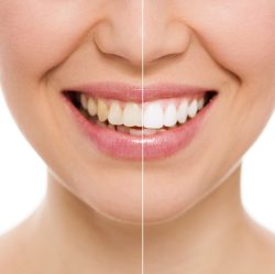 Six Month Smiles Before And After | Clear Braces & Aligners With Six Month Smiles