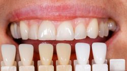 Zoom Teeth Whitening Services Near Me | Laser Teeth Whitening