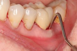 Dental Abscess Treatment Cost