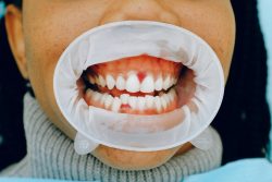 Gum Abscess Treatment in Houston