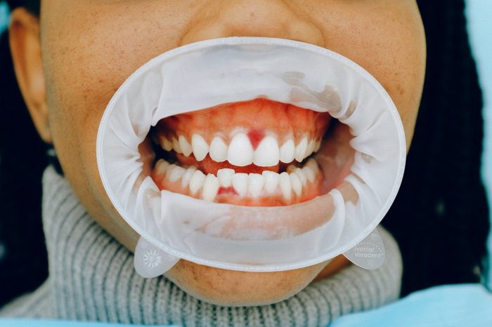 Gum Abscess Treatment in Houston